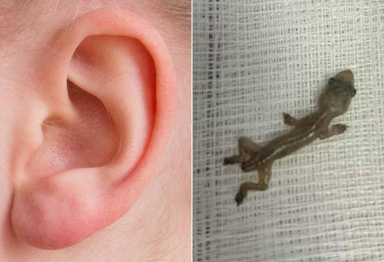 Paciente com dor de ouvido descobre lagartixa dentro da cabeça