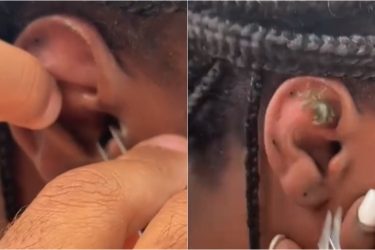 Vídeo: Mulher tem caranguejo removido de ouvido após mergulhar no mar