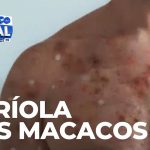 Maringá tem o primeiro caso registrado de varíola dos macacos