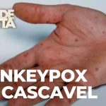 Caso confirmado: primeiro paciente diagnosticado com varíola dos macacos em Cascavel
