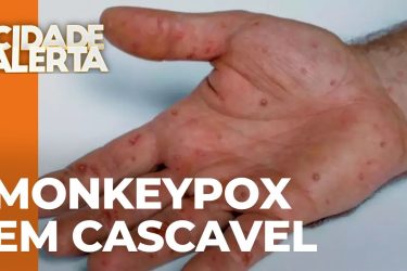 Caso confirmado: primeiro paciente diagnosticado com varíola dos macacos em Cascavel